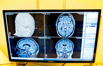 CT-bilde av pasient med Parkinsons sykdom