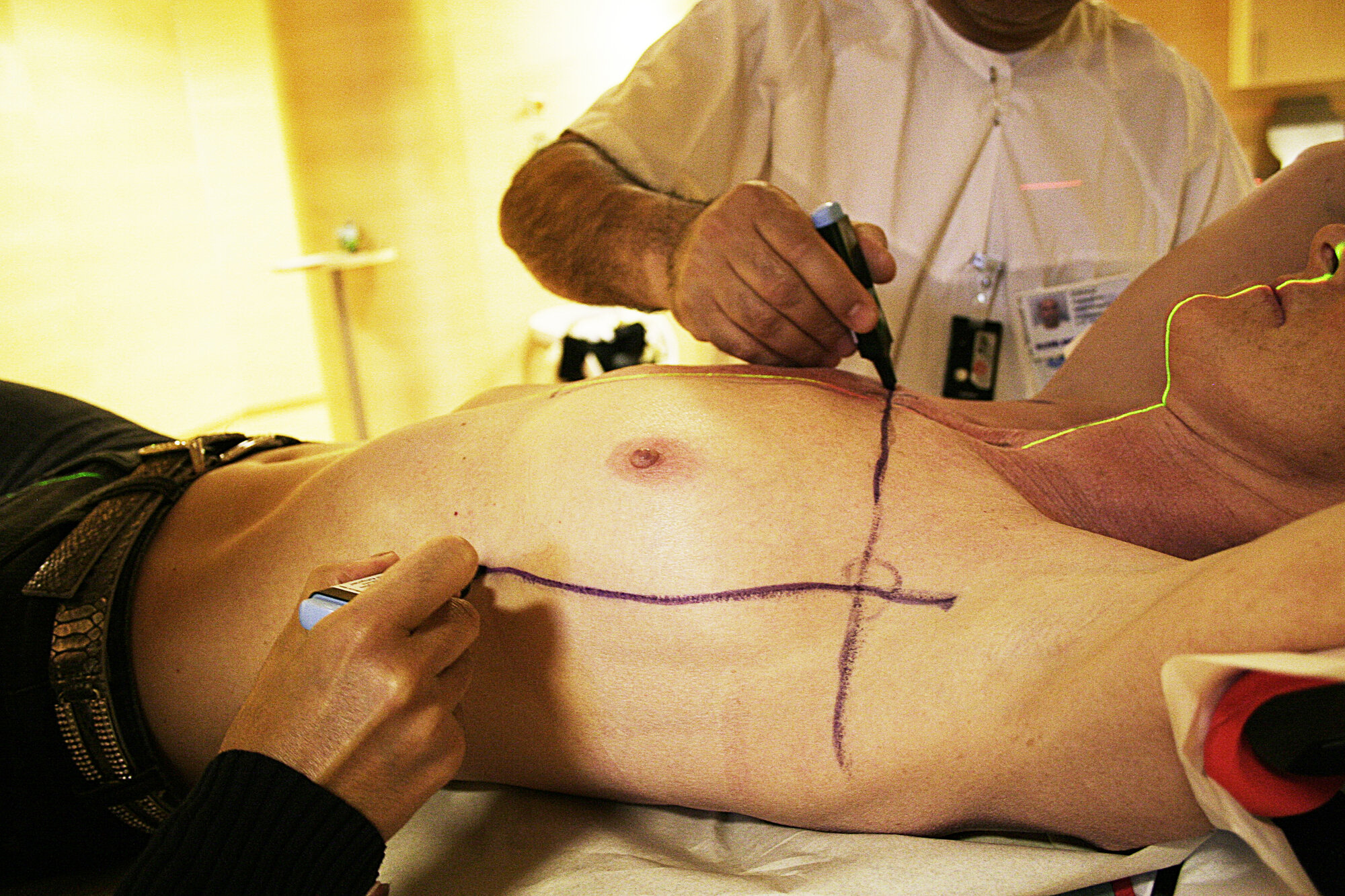 Bildet viser en kvinne med brystkreft som ligger klar til stråling. Legen tegner opp streker der det skal stråles.