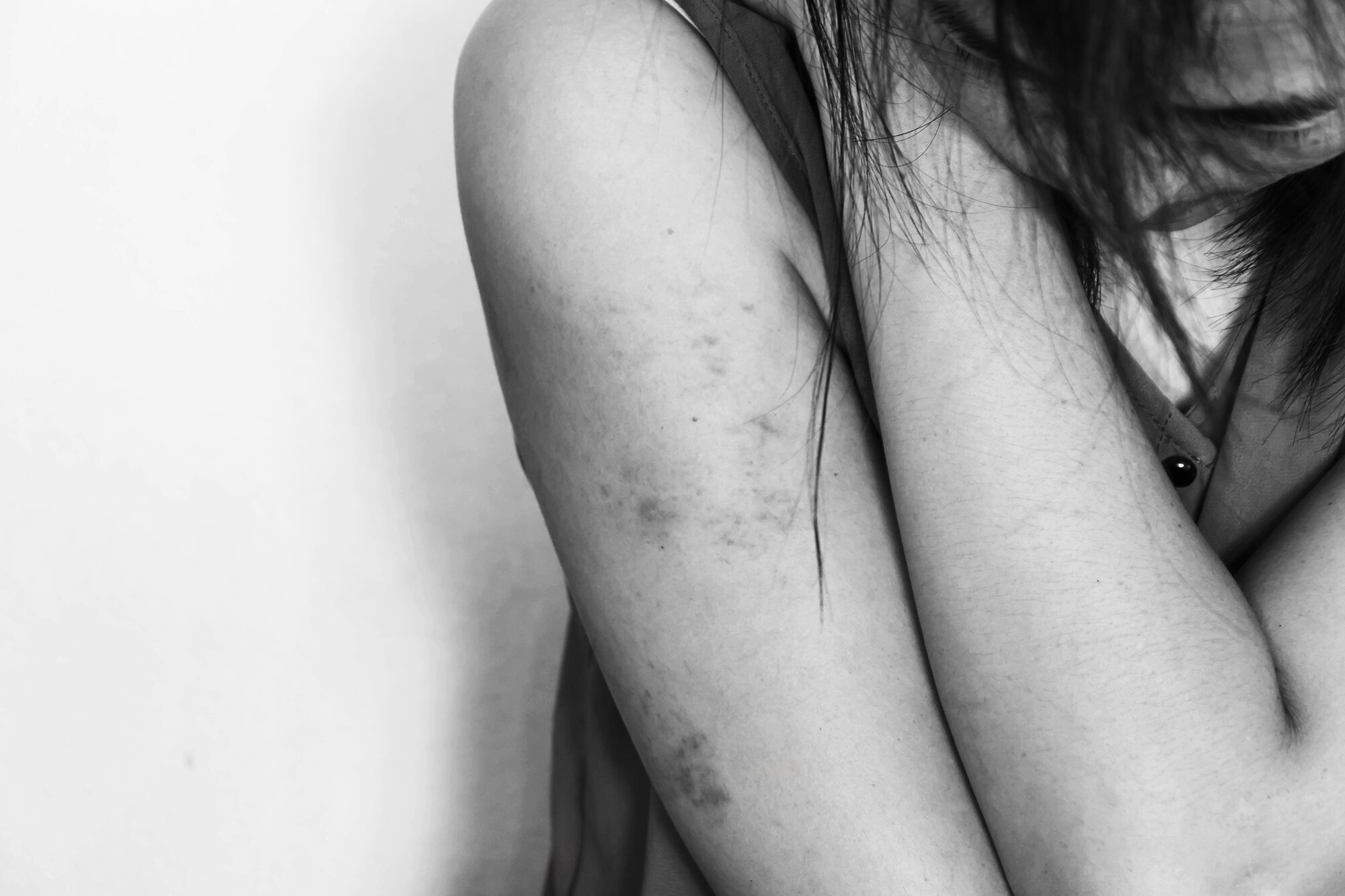 Bildet viser arbeide til et menneske som har blitt utsatt for vold. Armene har blåmerker.