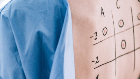 Bildet viser ryggen til en pasient påskrevet tall