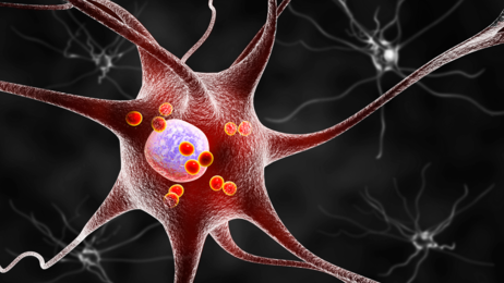 Grafisk illustrasjon av Parkinson-nerveceller