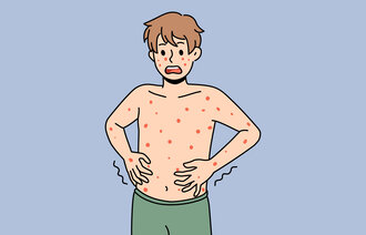 Illustrasjonen viser en mann med utslett på kroppen.