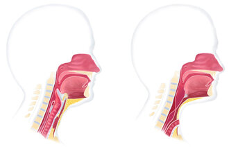 Illustrasjonen viser normal luftveisanatomi før operasjon og etter operasjon, der strupen er operert bort og luftrøret lagt frem på halsen.