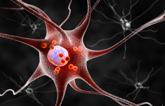 Grafisk illustrasjon av Parkinson-nerveceller