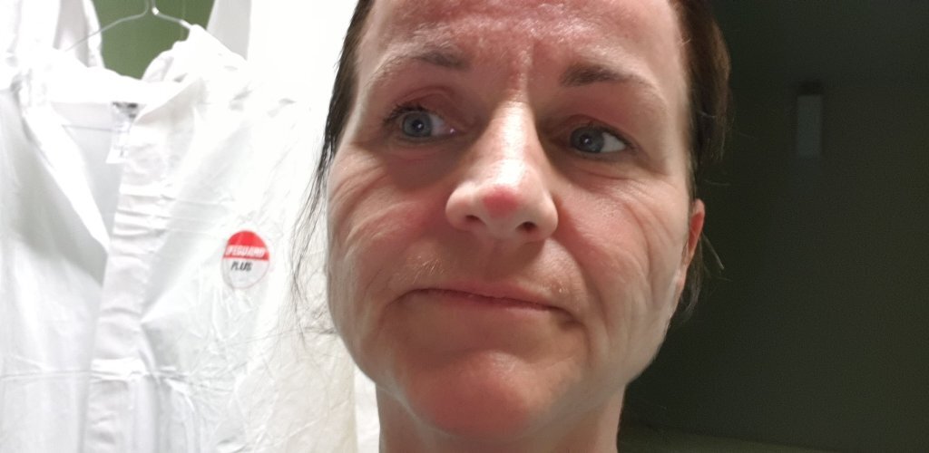 Bildet viser Janecke Engeberg Sjøvold med merker etter munnbind i ansiktet.