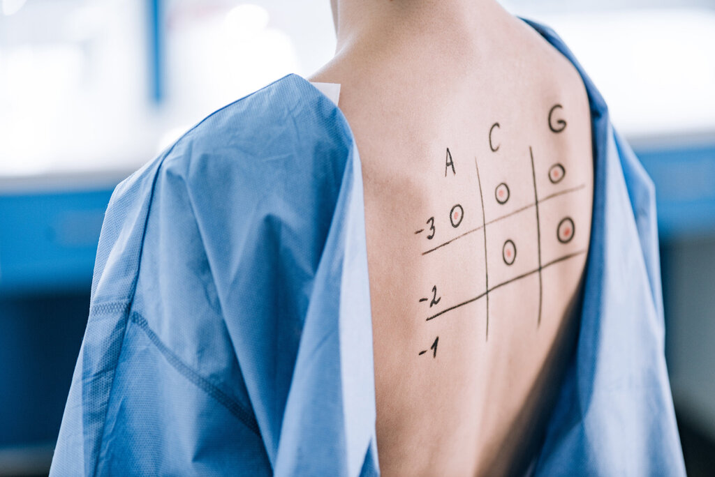 Bildet viser ryggen til en pasient påtegnet tall
