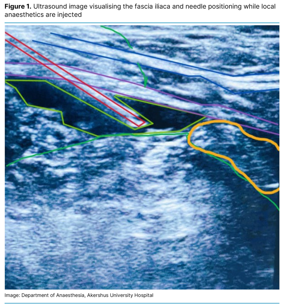 Figure 1. Ultrasound image visualising the fascia iliaca and needle positioning while local anaesthetics are injected