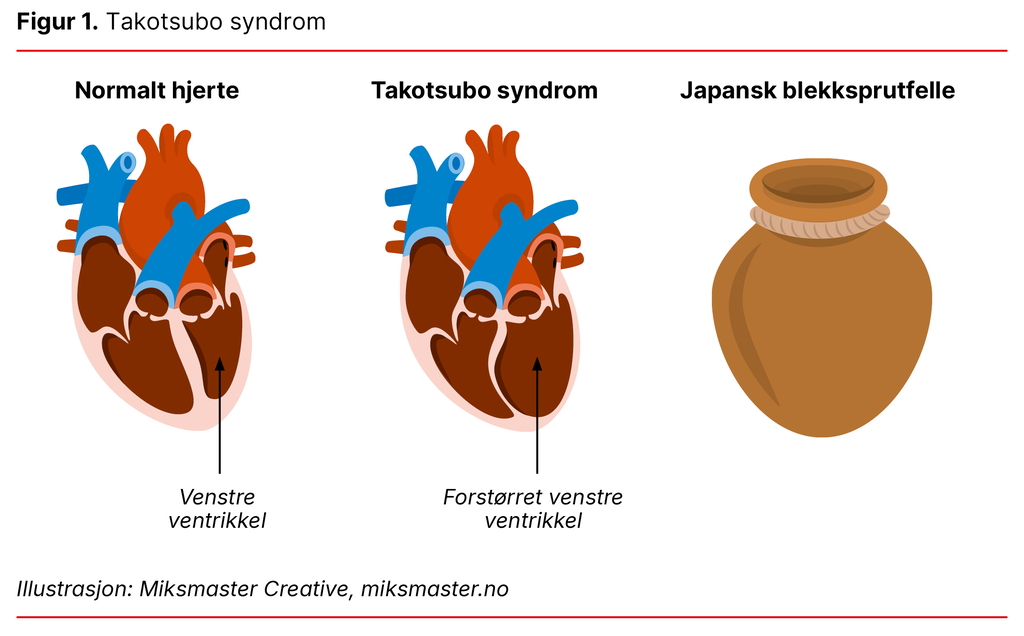 Figur 1. Takotsubo syndom