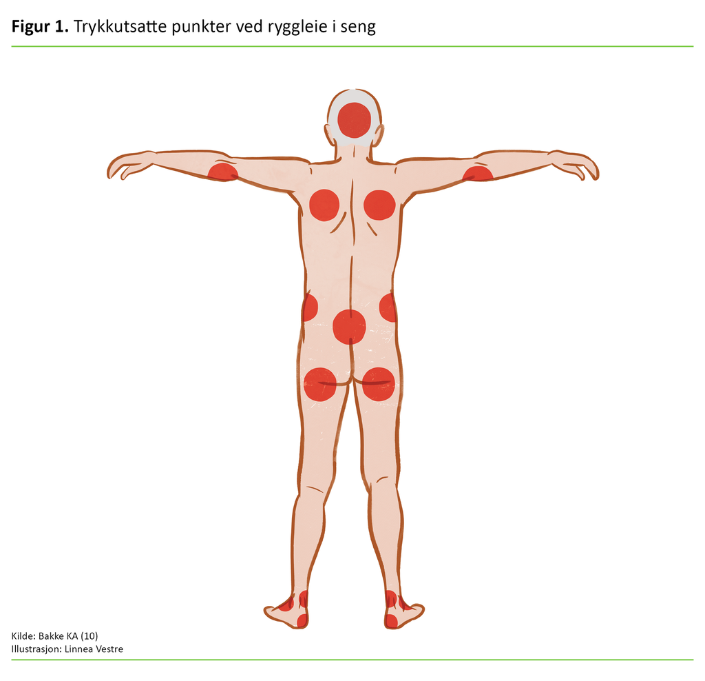 Figur 1. Trykkutsatte punkter ved ryggleie i seng 