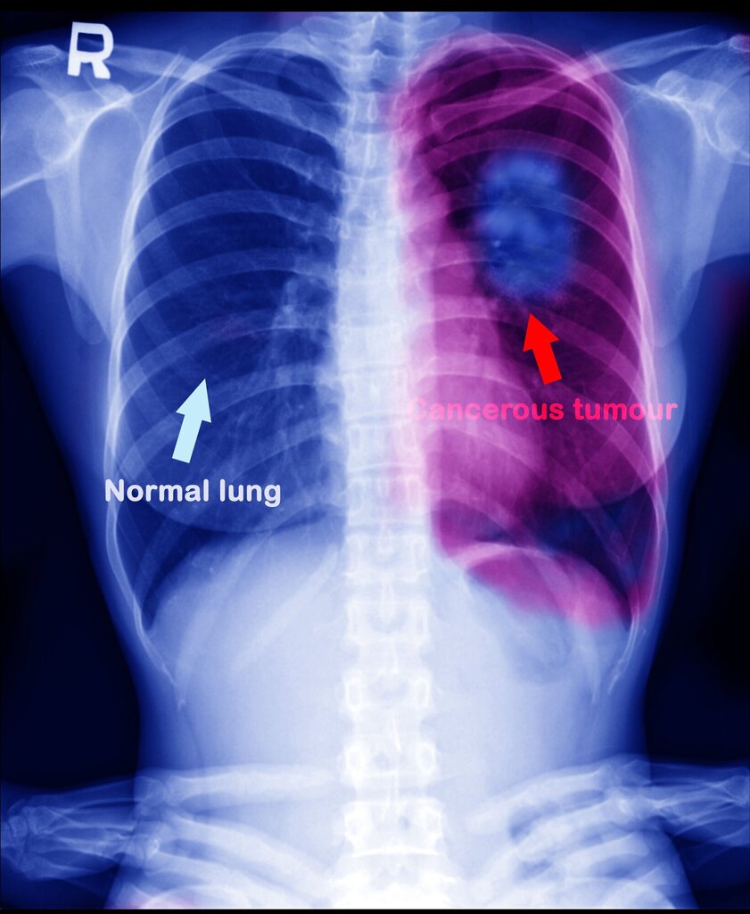 Røntgenbilde av lunger. En frisk lunge, og en lunge med kreftsvulst.