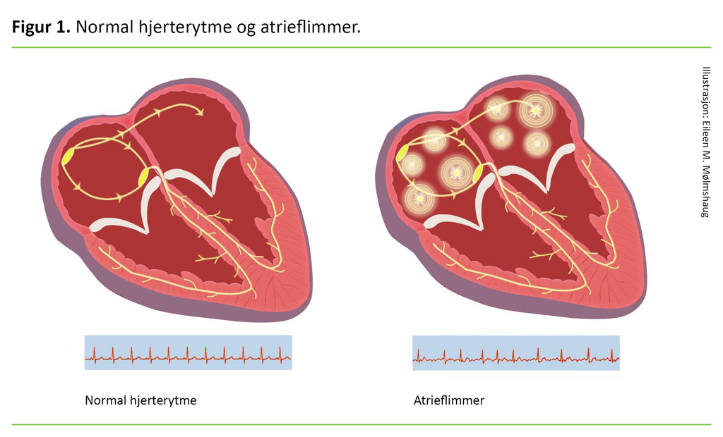 Figur 1. Tegning av to hjerter. Det ene med normal hjerterytme, det andre med atrieflimmer.