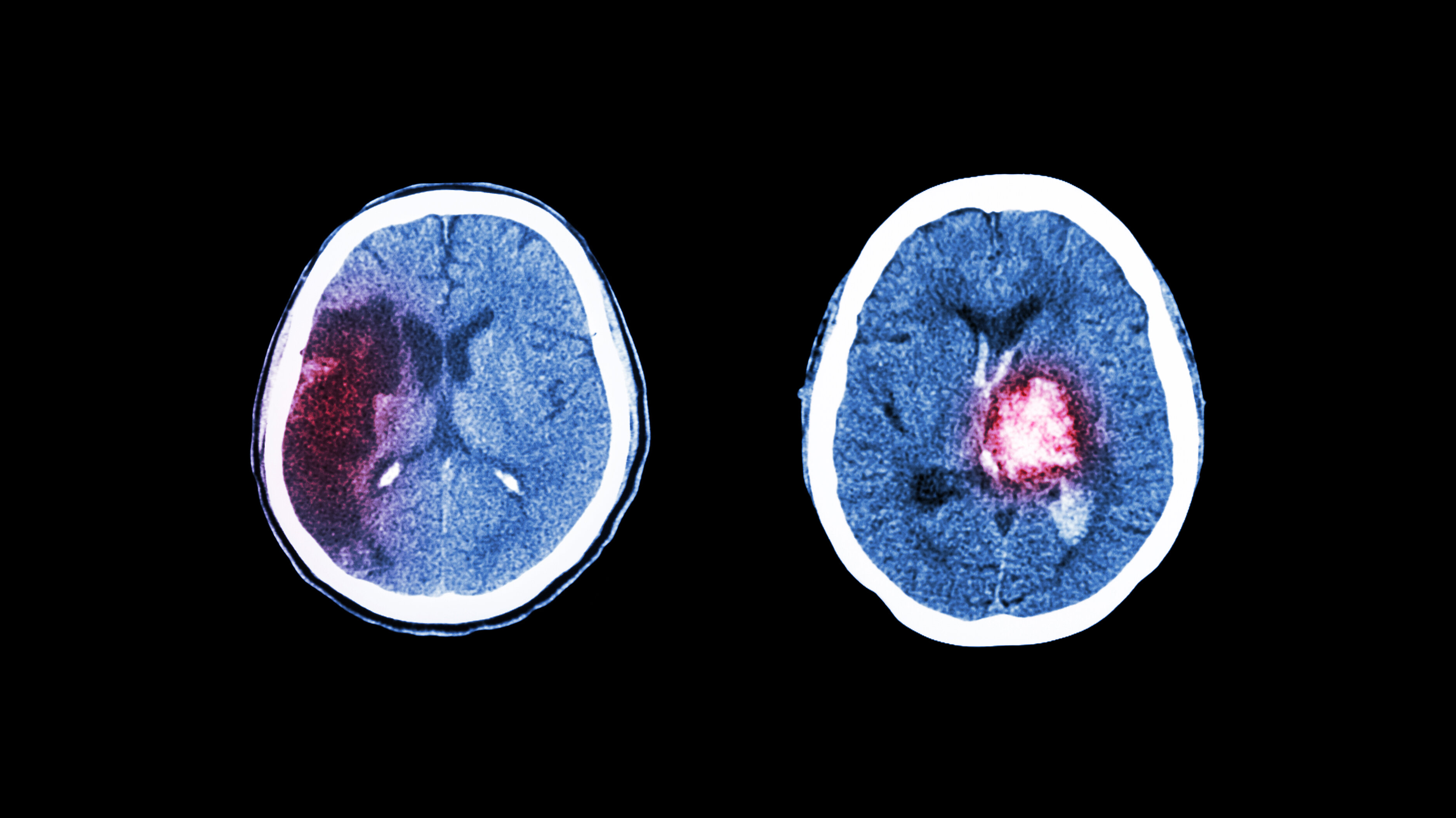 Hjerneslag Bildet viser en CT-skanning av hjerneslag på grunn av cerebralt infarkt og blodpropp