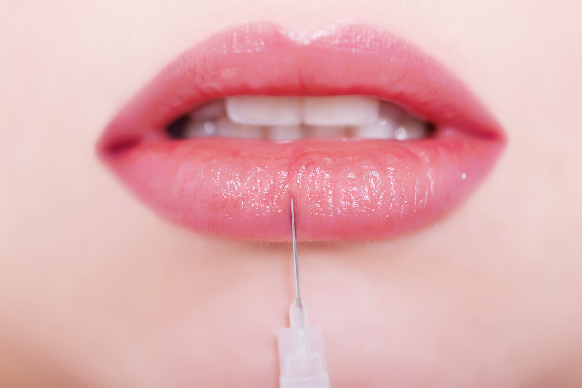 Bildet viser en sprøyte med botox som injiseres i kvinnelepper.
