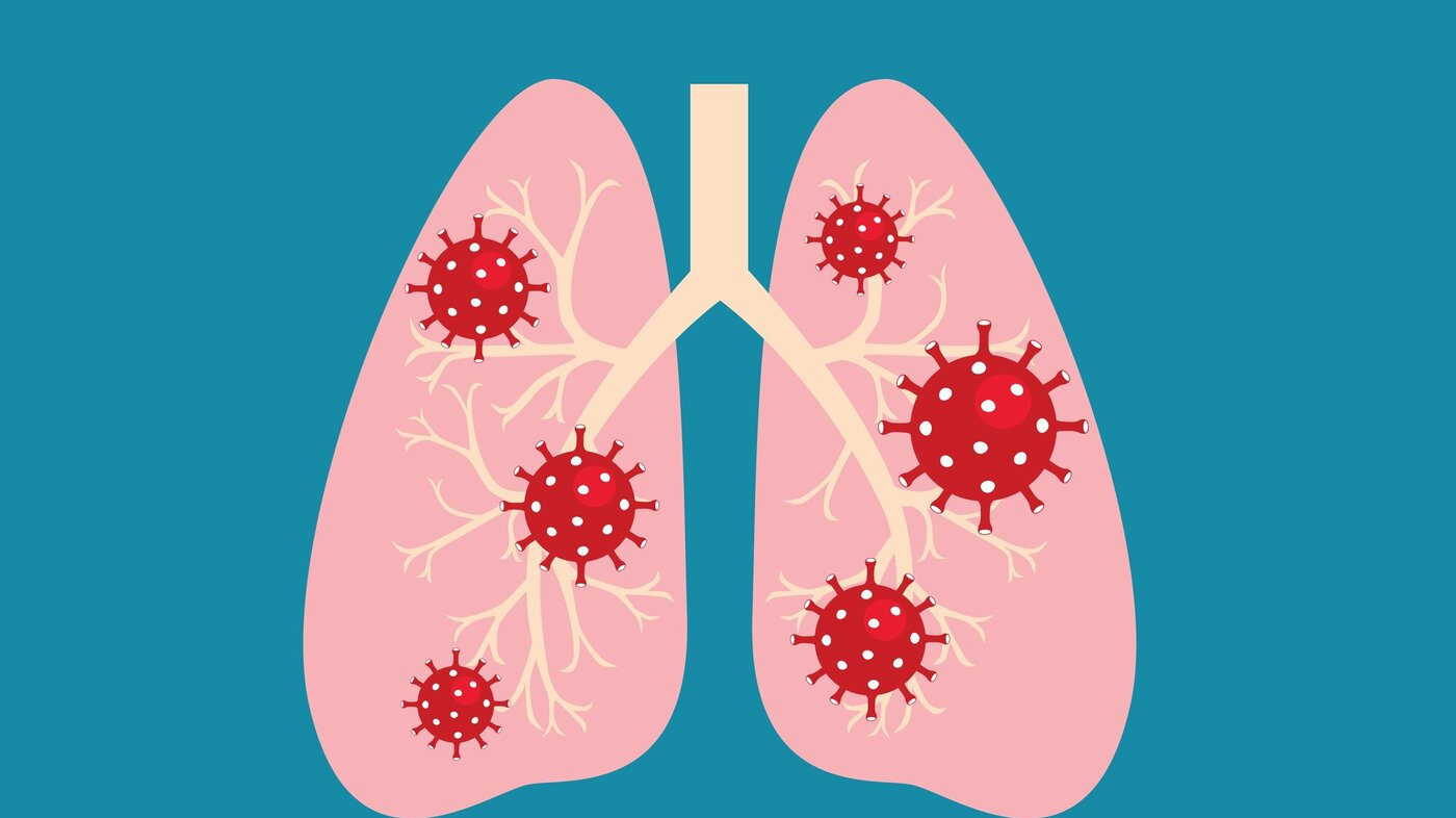 Illustrasjonen viser lunger med koronavirus.