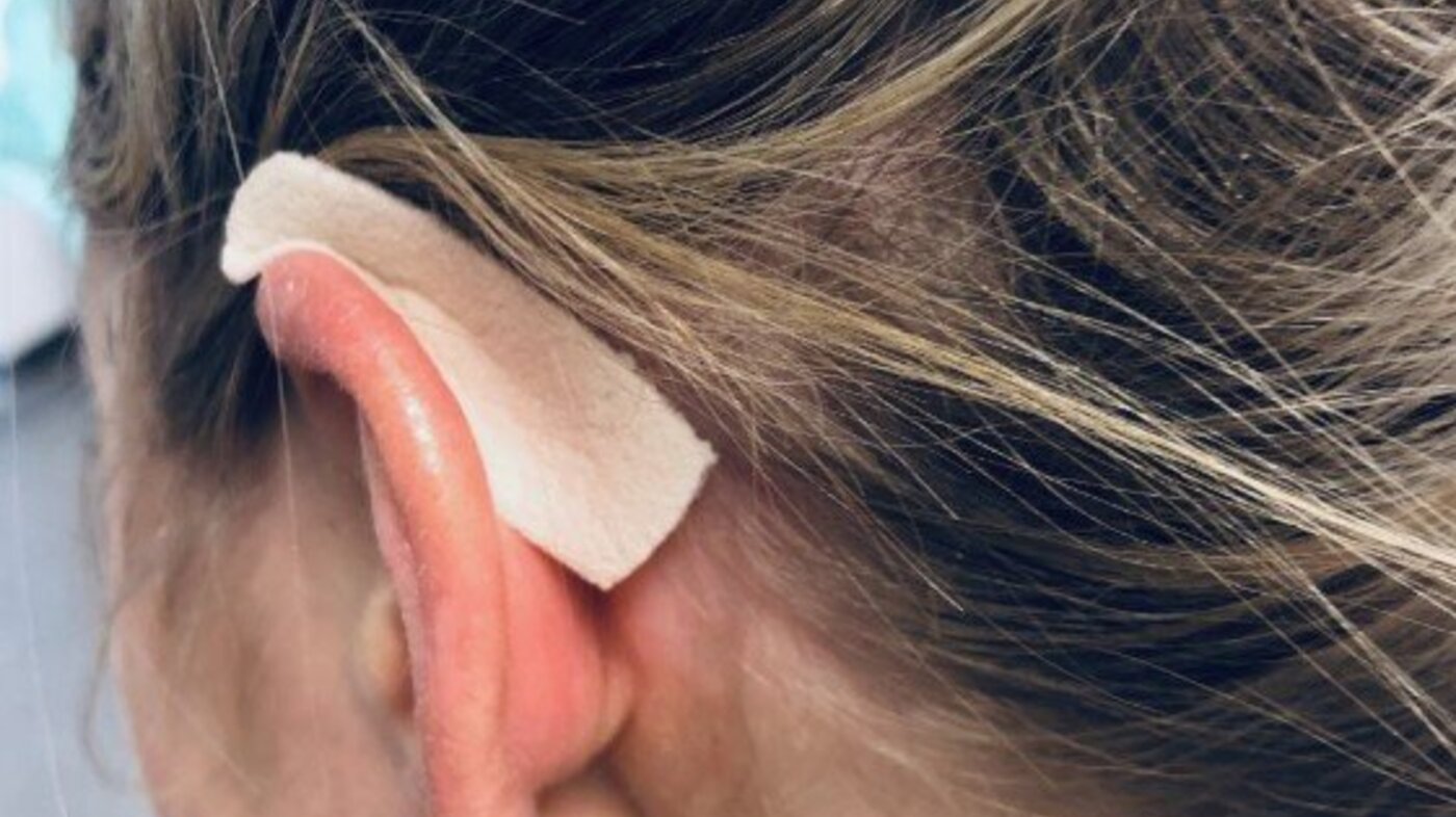 Bildet viser en sykepleier som har teipet polstring bak øret for å beskytte mot strikken på masken