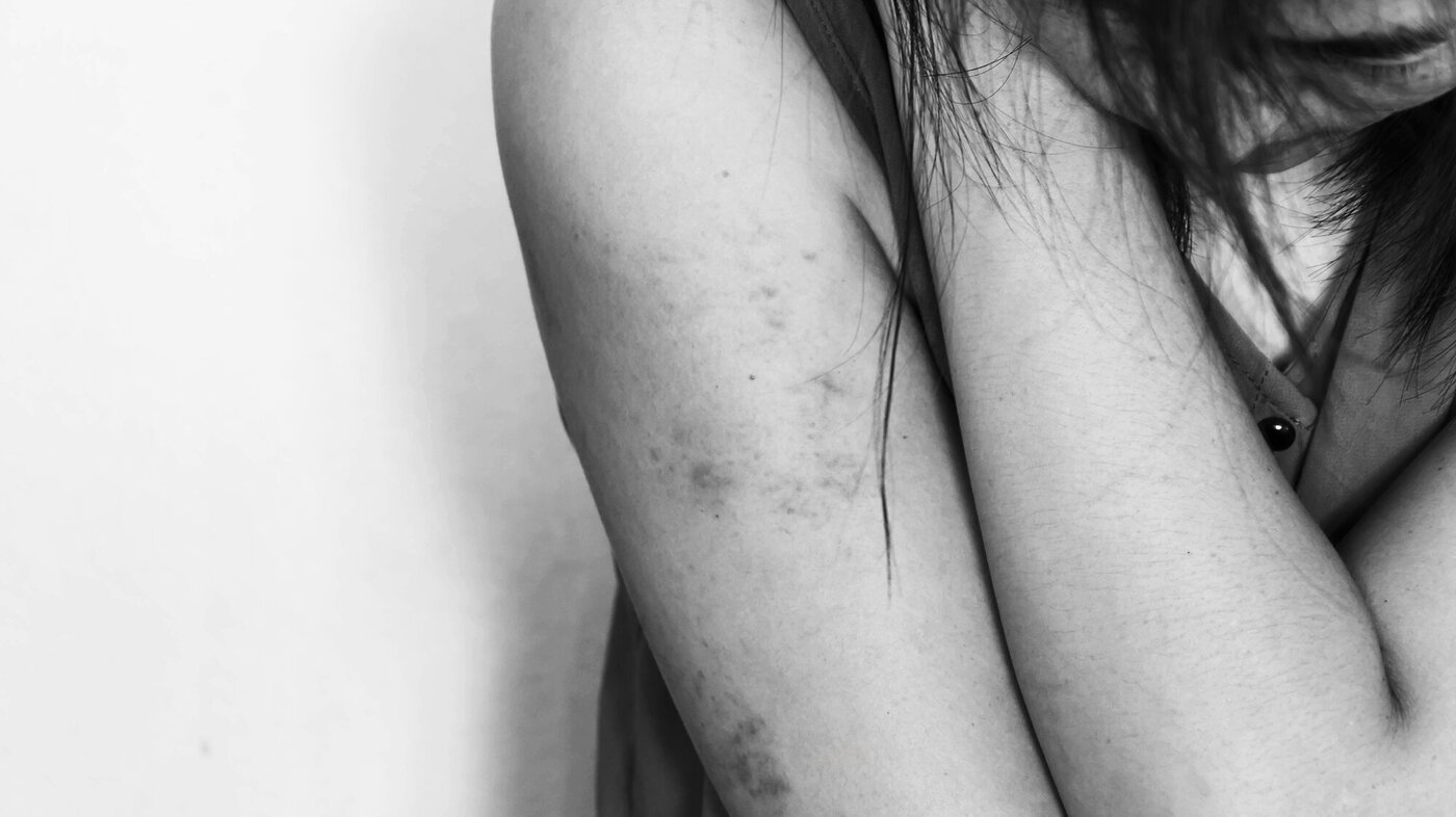 Bildet viser arbeide til et menneske som har blitt utsatt for vold. Armene har blåmerker.