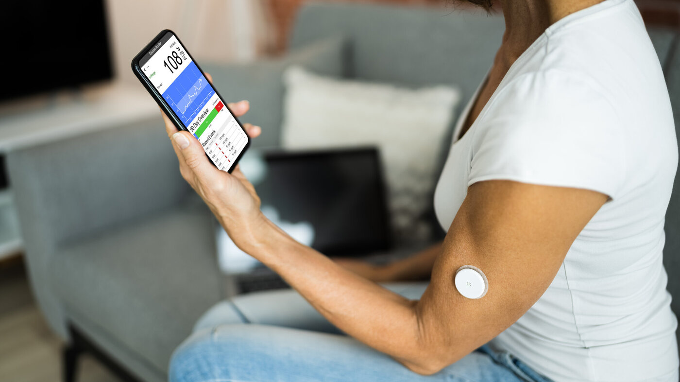 CGM (kontinuerlig glukosemåling) Bildet viser en kvinnelig pasient som bruker CGM (kontinuerlig glukosemåling) for å måle blodsukkeret. Verdiene sendes via bluetooth til mobilen.