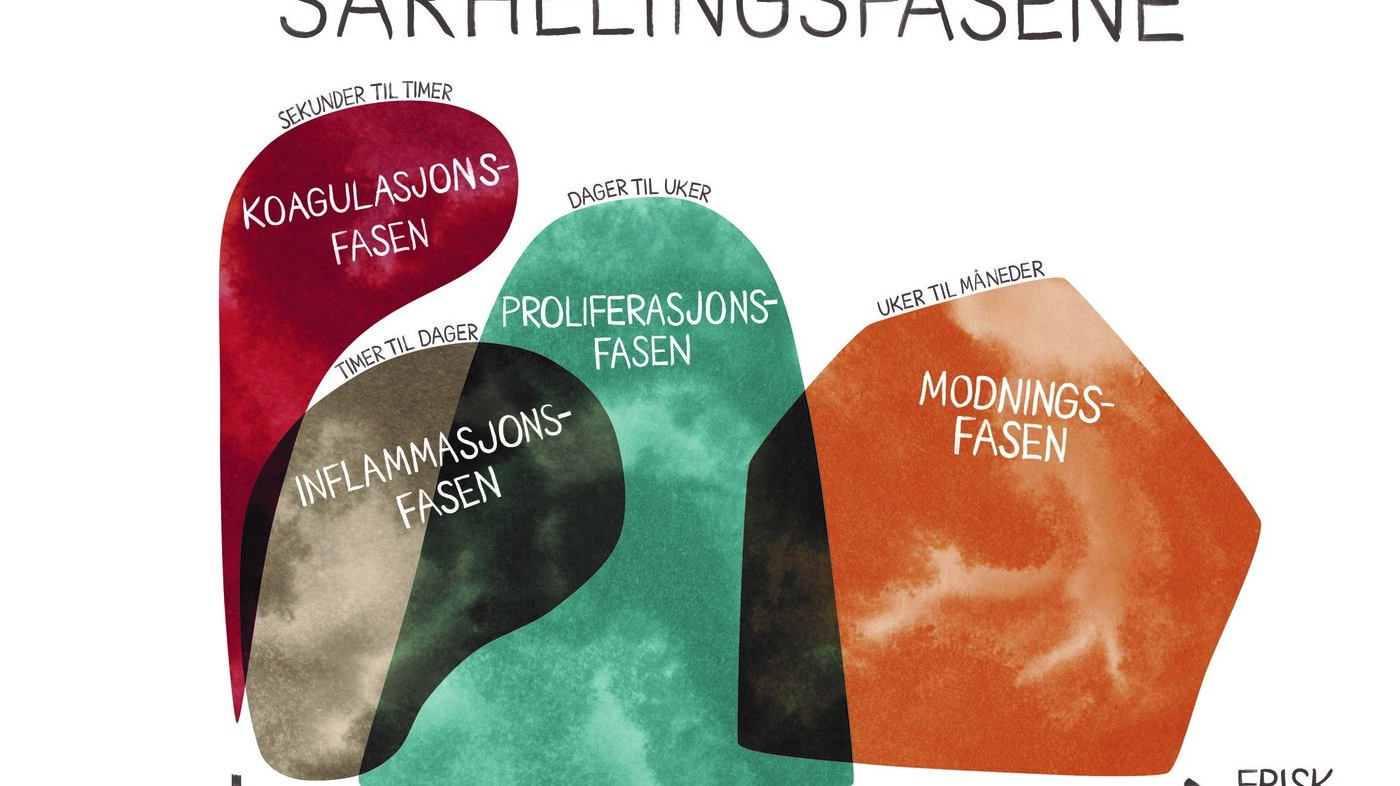 Sårhelingsfasene Illustrasjonen viser de fire sårhelingsfasene.