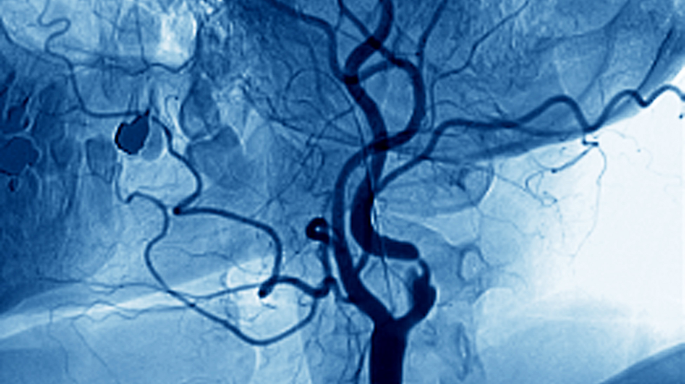 Angiogram av en innsnevret arterie i nakken. Bildet viser et angiogram av en innsnevret arterie i nakken.