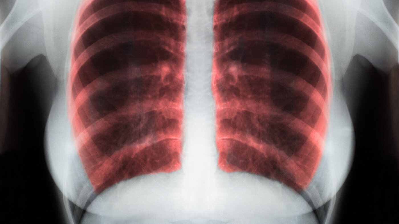 Bildet viser et røntgenbilde av noen lunger, der lungene er farget røde.