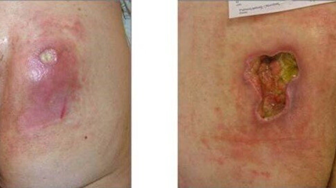Bildet viser et sår før og etter debridering