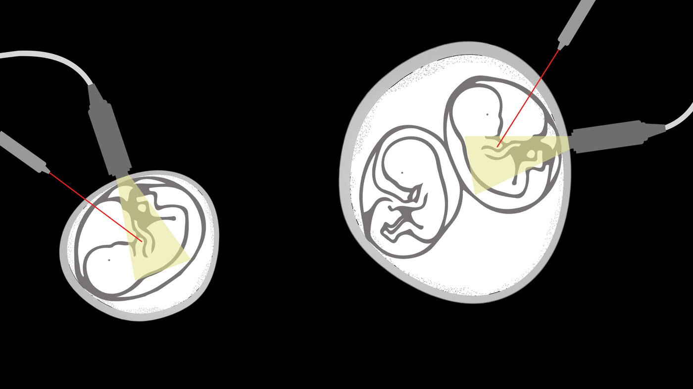 Fosterreduksjon Illustrasjon som viser fosterreduksjon der det er ett embryo, og ett hvor det er to.