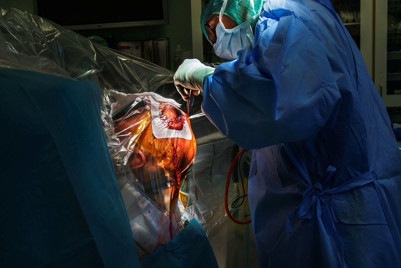 Parkinsonoperasjon Operasjon av pasient med Parkinsons sykdom. Nevrokirurg Ane Konglund, OUS