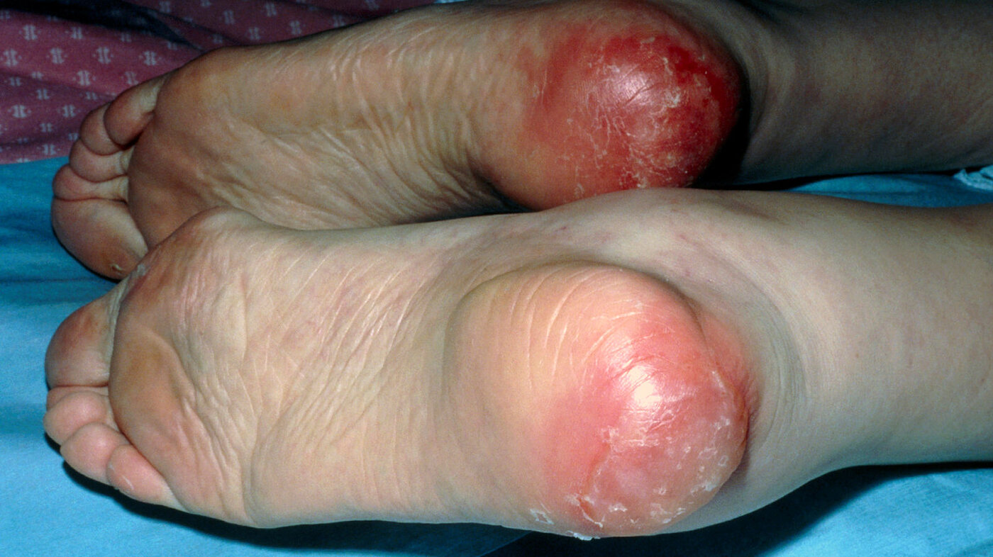 Bildet viser en pasient med trykksår på begge hælene.
