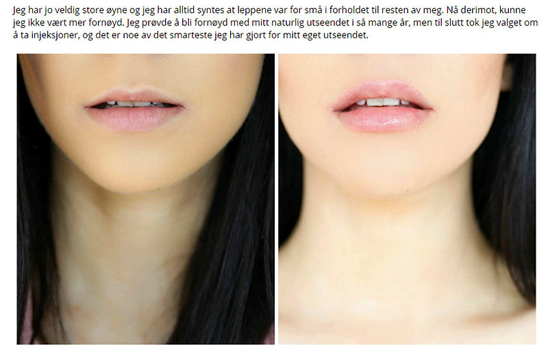 Filler i leppene Bildet viser før-og-etter-bilder av bloggeren Stina Marie Bakken, som har tatt Restylane i leppene.