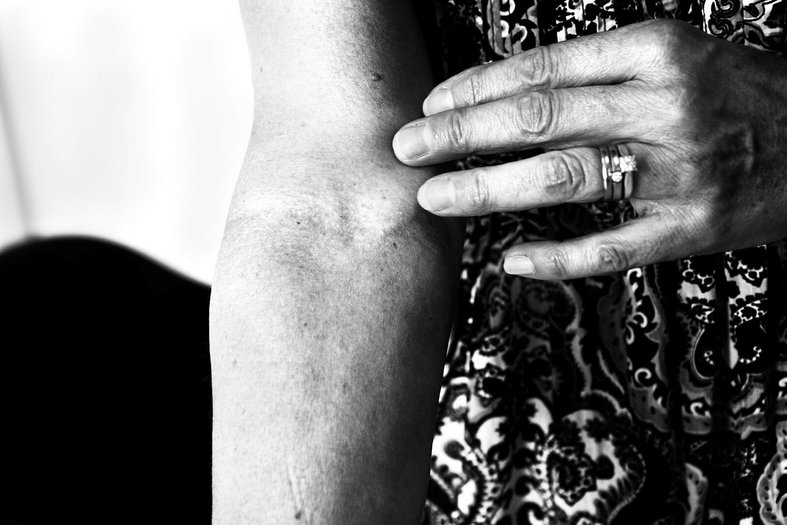 Hånd og arm Hånd og arm