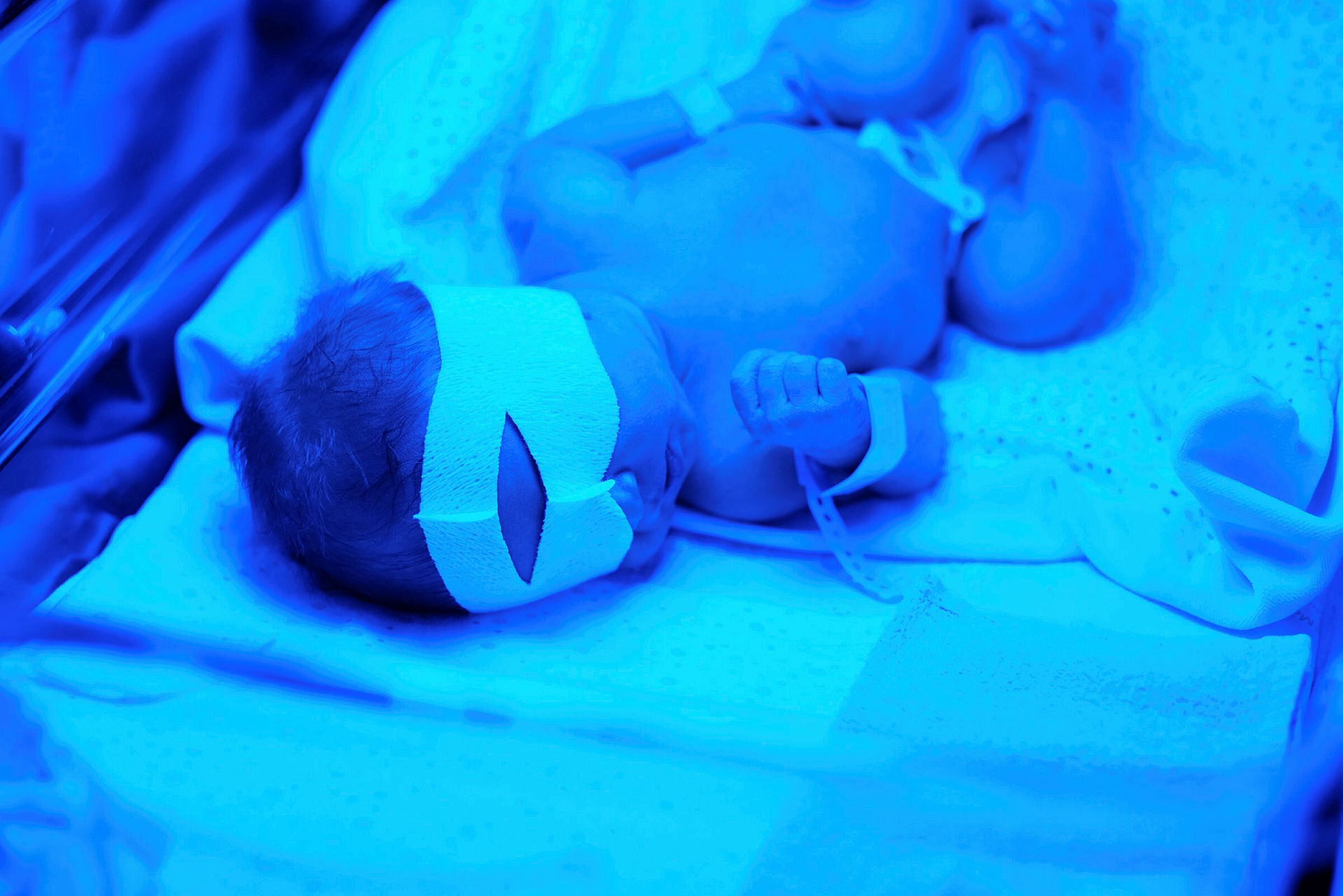 Nyfødt baby får fototerapi Bildet viser en nyfødt baby som ligger i en lyskasse og får lysterapi mot gulsott.