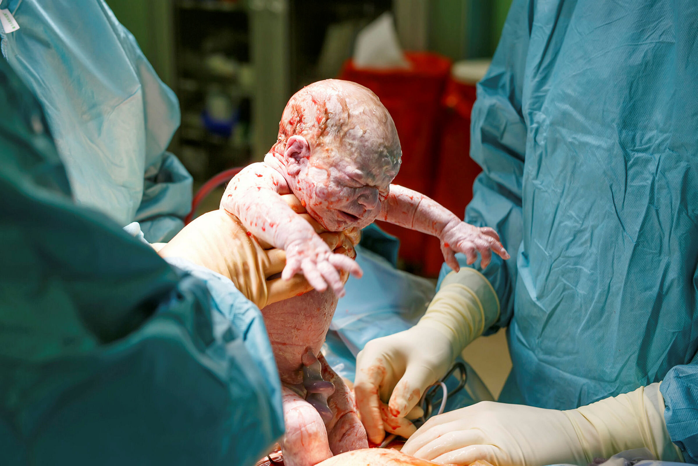 Baby som blir født ved keisersnitt Bildet viser en baby som akkurat er født ved keisersnitt