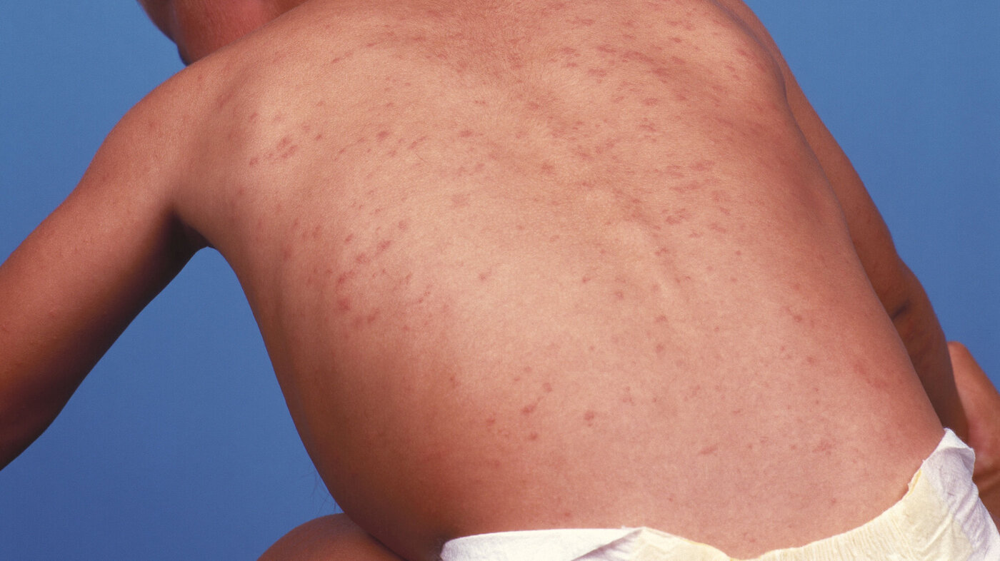 Bilde viser ryggen til et barn som har utslett fra meslinger