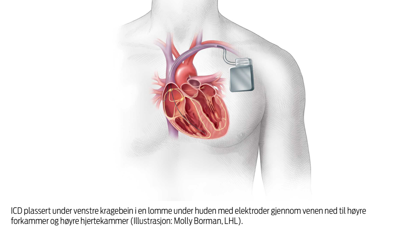 Figur 1. Implantert hjertestarter (ICD)