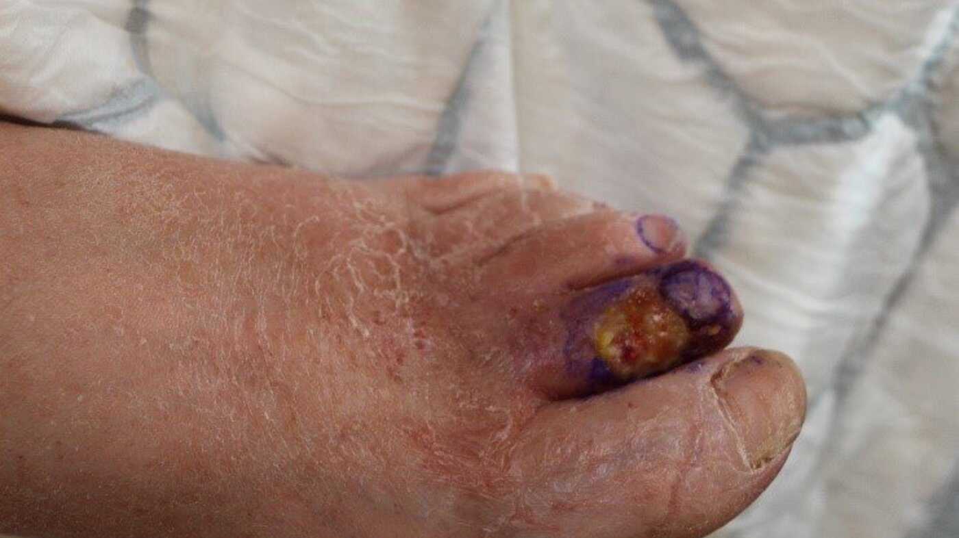 Bildet viser en fot med et lite sår på andre tå