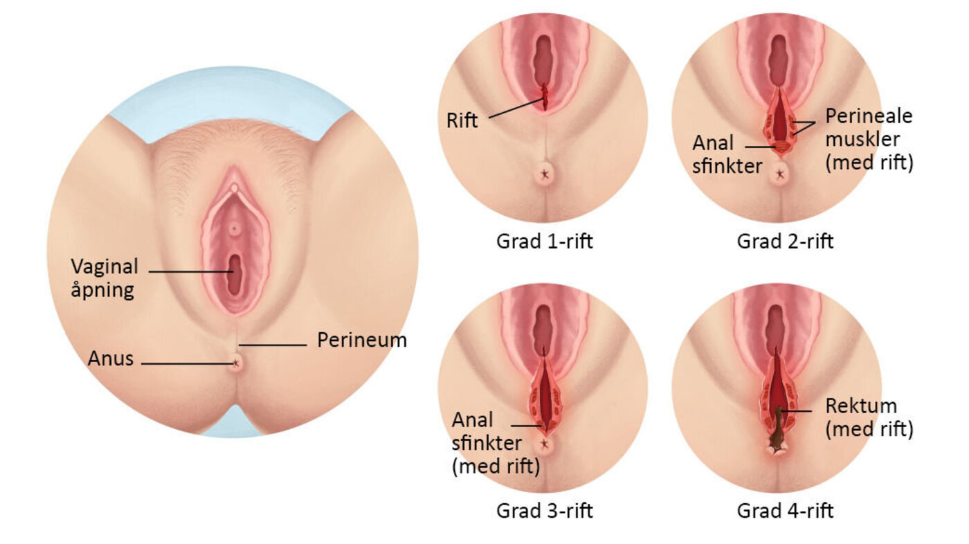 Illustrasjonen viser fire grader av vaginale rifter som kan oppstå i forbindelse med fødsel