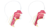 Illustrasjonen viser normal luftveisanatomi før operasjon og etter operasjon, der strupen er operert bort og luftrøret lagt frem på halsen.