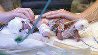 Bildet viser et ekstremt prematurt barn.