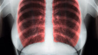 Bildet viser et røntgenbilde av noen lunger, der lungene er farget røde.