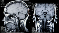 Røntgenbilde av hodeskalle