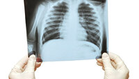 Røntgenbilde av lunger