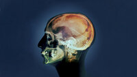 Bildet viser et røntgenbilde av et hode sett fra siden, der man kan se shunten inne i hodet.
