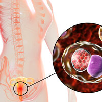 3D-illustrasjonen viser en kvinne med nærbilde av bakterien chlamydia trachomatis, som har infisert cellene i livmorhalsen