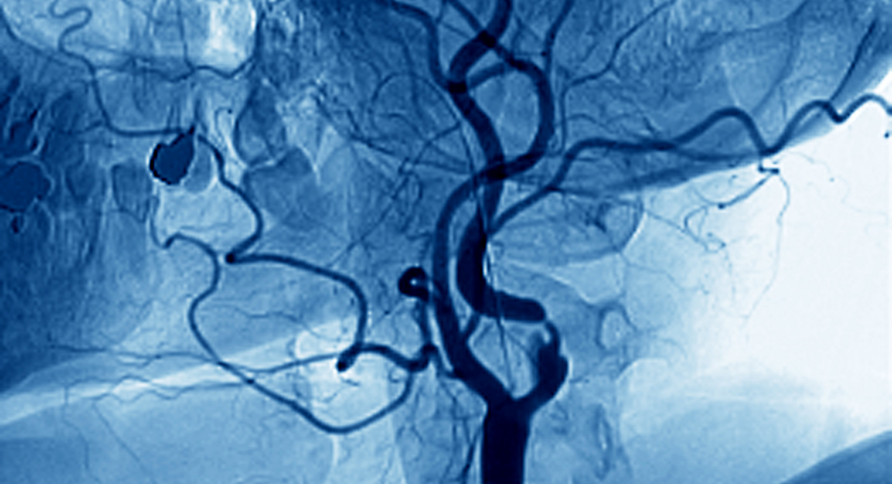 Bildet viser et angiogram av en innsnevret arterie i nakken.